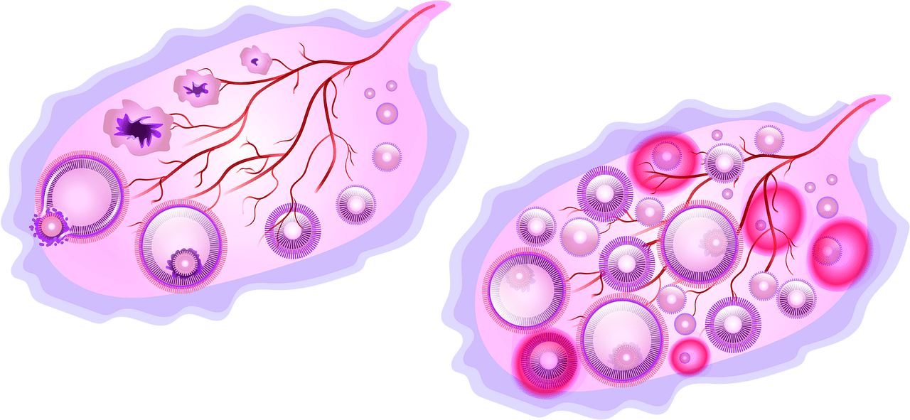 Ovarian cysts