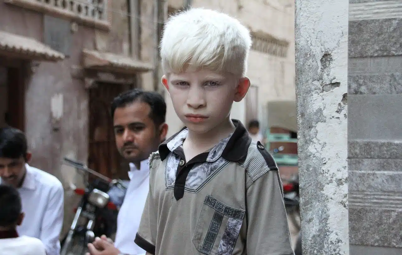 albino child