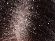 Dandruff