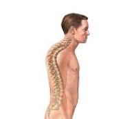 Kyphosis