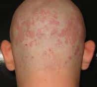 Dermatitis