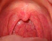 Dysphagia