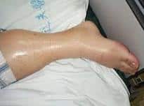 Edema