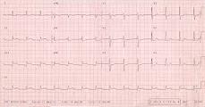 Electrocardiogram