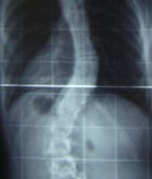 Scoliosis