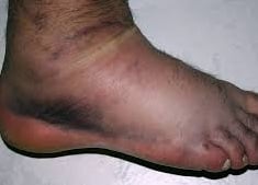 Sprain