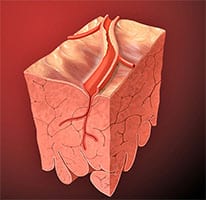 Ischemia