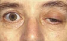 Myasthenia