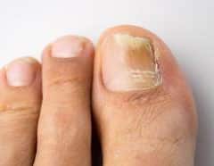 Onychomycosis