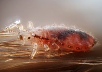 Pediculosis