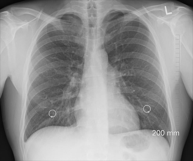 X-ray of the lungs