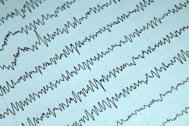 Electrophysiology electrocardiogram